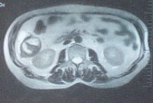 cistoadenoma_hepatico_tomografia1