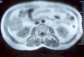 cistoadenoma_hepatico_tomografia3
