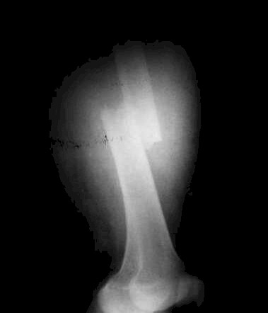 fractura_femur