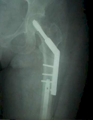 fractura_intertrocanterica_dhs fractura_intertrocanterica_dhs