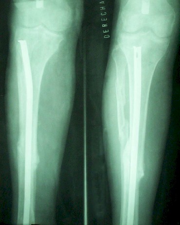 intramedular_fractura_tibia