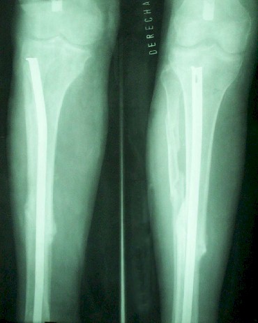 intramedular_fractura_tibia