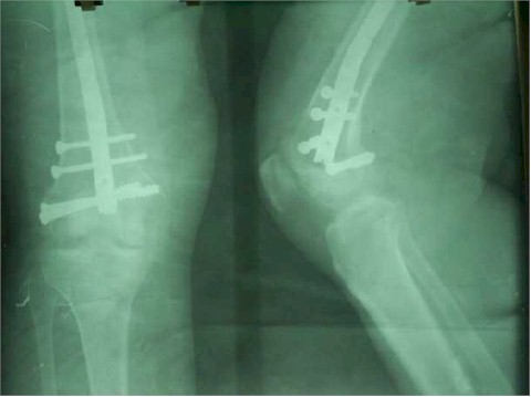 intramedular_retrogrado_fractura_intercondilea intramedular_retrogrado_fractura_intercondilea