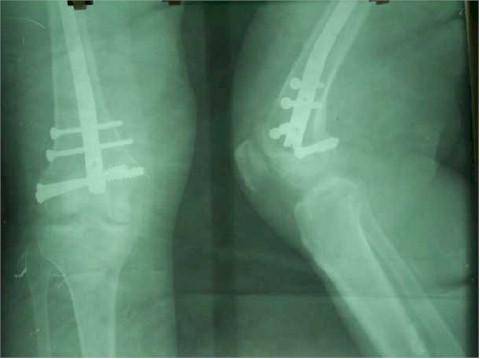 intramedular_retrogrado_fractura_intercondilea