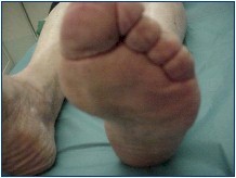 metatarsalgia