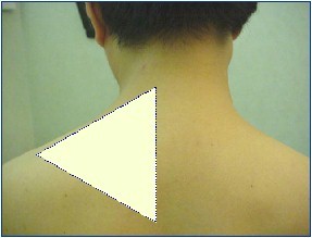 fibromialgia