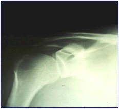 calcificacion