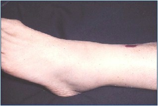 sinovitis