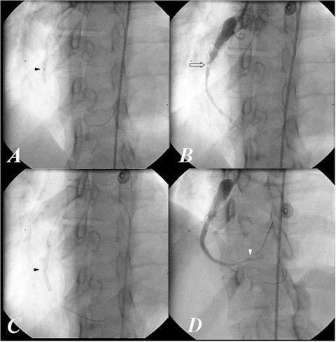 ectasia_coronaria_implantacion_stent