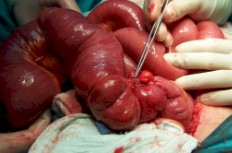 endometriosis_estenosis_valvula_Bawin endometriosis_estenosis_valvula_Bawin