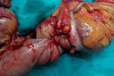 endometriosis_hemicolectomia_derecha endometriosis_hemicolectomia_derecha