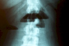 endometriosis_niveles_hidroaereos endometriosis_niveles_hidroaereos