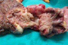 endometriosis_valvula_Bawin endometriosis_valvula_Bawin