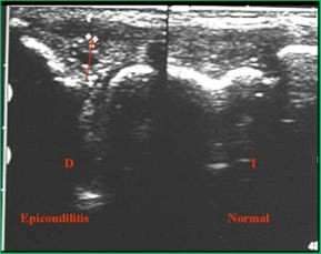 epicondilitis_ecografia