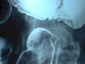 estenosis_benigna_colon2