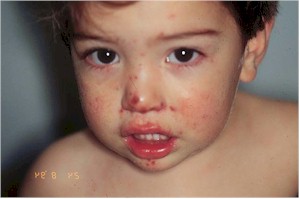 faringoamigdalitis_impetigo faringoamigdalitis_impetigo