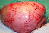 fibromatosis_mesenterica3