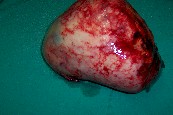 fibromatosis_mesenterica4