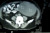 fibromatosis_mesenterica_rx2