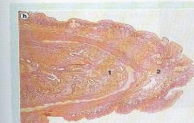 fimosis_fisiologica_pene_fetal fimosis_fisiologica_pene_fetal