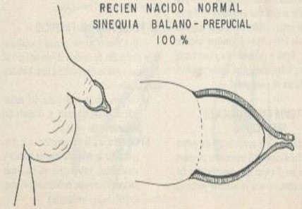 fimosis_fisiologica_sinequias_balanoprepuciales