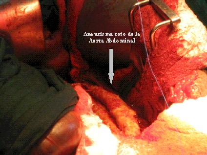 fistula_aortoenterica_primaria