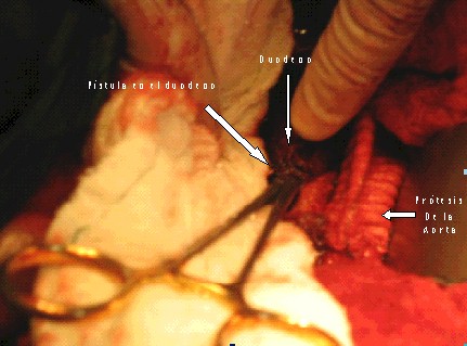 fistula_aortoenterica_primaria2 fistula_aortoenterica_primaria2