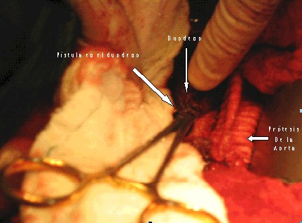 fistula_aortoenterica_primaria2