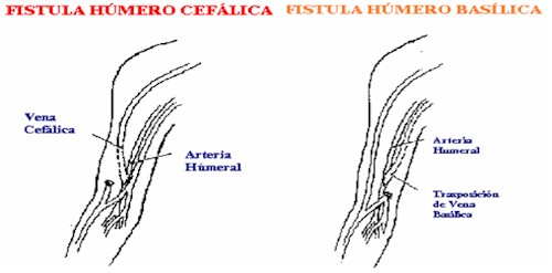 fistula_humero