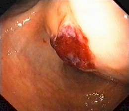 gastrectomia_total_endoscopia_gastrica