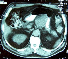 gastrectomia_total_tumor_curvatura