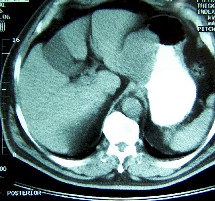 gastrectomia_total_tumor_curvatura2