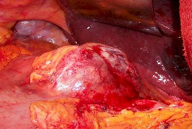 gastrectomia_total_tumor_vista_intraoperatoria