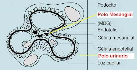 glomerulonefritis_aguda