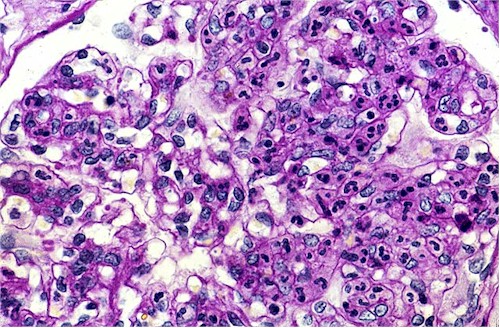 glomerulonefritis_aguda_histopatologia