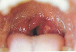 glomerulonefritis_aguda_infeccion glomerulonefritis_aguda_infeccion