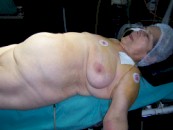 hernia_morgani3 hernia_morgani3