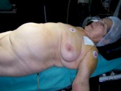 hernia_morgani3