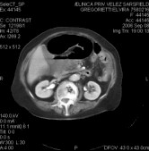 hernia_morgani6 hernia_morgani6