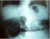 hernia_morganirx3 hernia_morganirx3