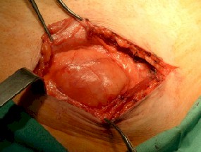 hernia_spiegel_diseccion