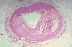 iam_arteria_coronaria_ateromatosa iam_arteria_coronaria_ateromatosa