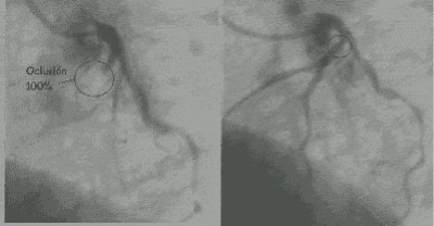 iam_arteriografia_coronaria2