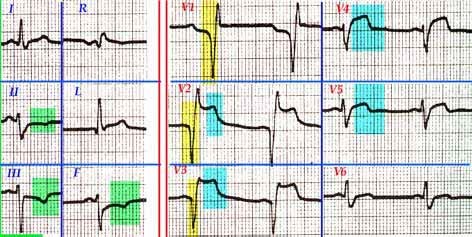 iam_ecg iam_ecg