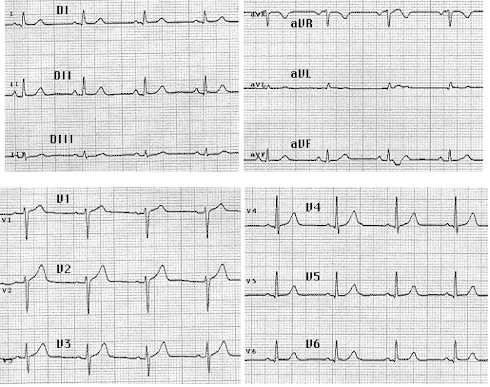 iam_electrocardiograma_normal