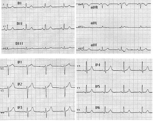 iam_electrocardiograma_normal iam_electrocardiograma_normal