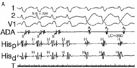 iam_fibrilacion_ventricular