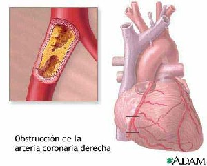 iam_obstruccion_arteria_coronaria iam_obstruccion_arteria_coronaria