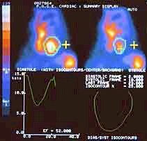 iam_ventriculografia_isotopica iam_ventriculografia_isotopica