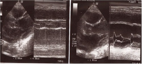 infarto_miocardio_ecocardiograma